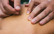 Acupuncture